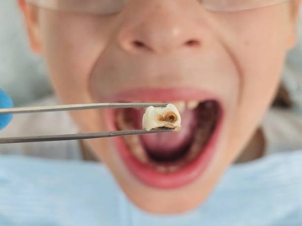 Best Emergency Dental Care for Broken or Chipped Teeth in Riverse, ID